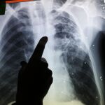 En la imagen, la radiografía de un paciente aquejado de tuberculosis