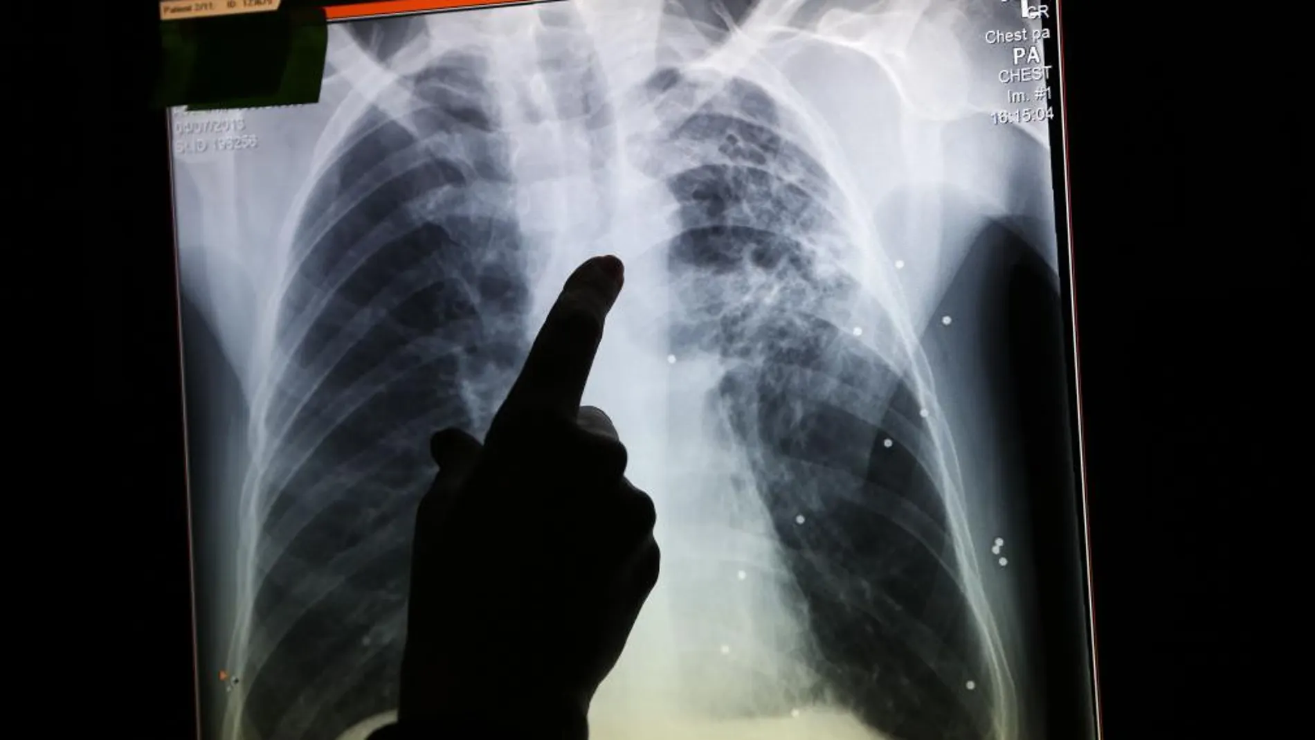 En la imagen, la radiografía de un paciente aquejado de tuberculosis