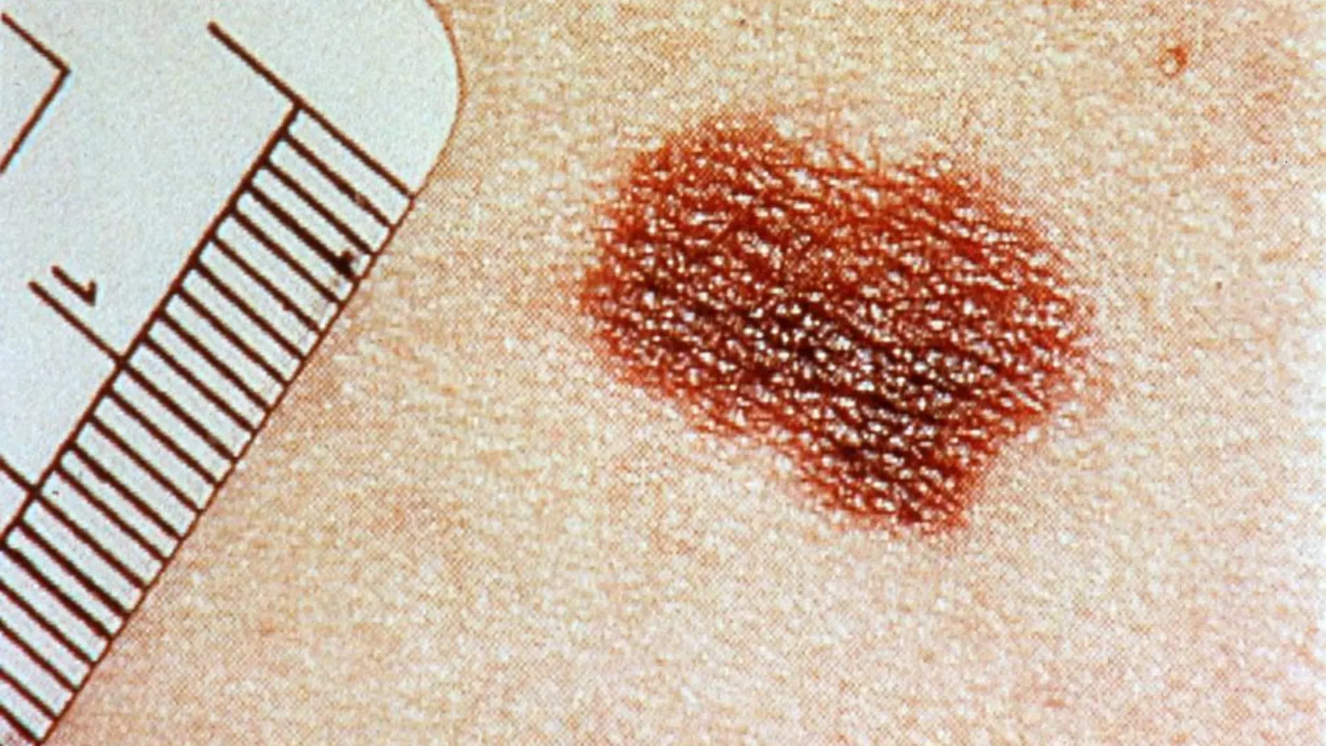 Fotografía de un melanoma en la piel