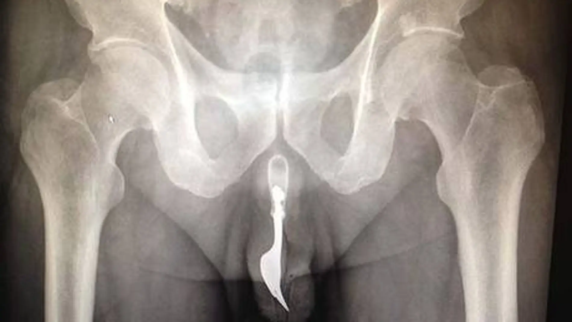 Radiografía del cuerpo extraño incrustado en la uretra del paciente