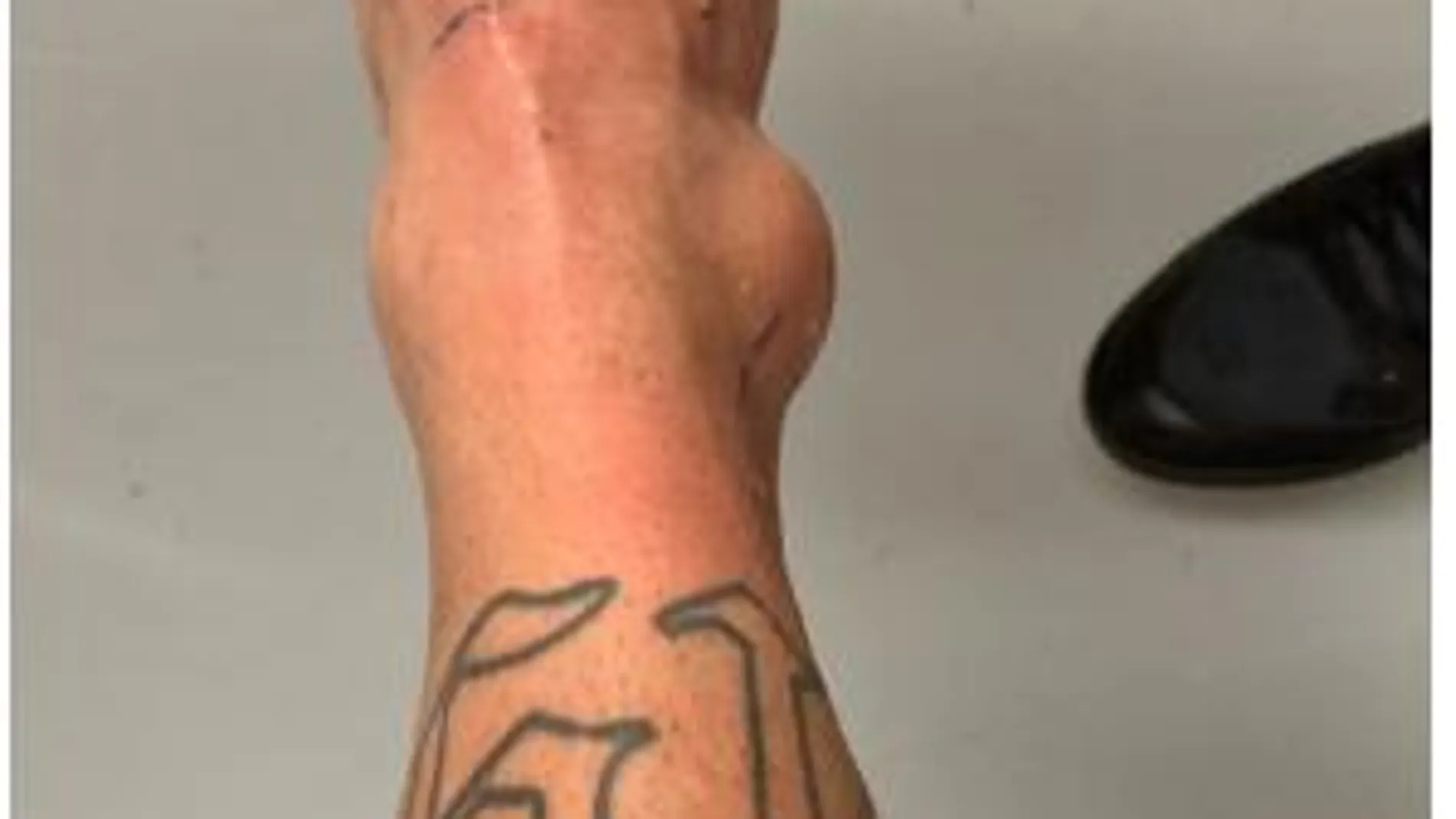 Así quedó el tobillo de Neymar tras su lesión