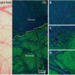 Comparación de dos imágenes de tejido cerebral canceroso, una obtenida con microscopía convencional (izquierda) y la otra mediante SRS (derecha). En la última se aprecian claramente los límites del área tumoral