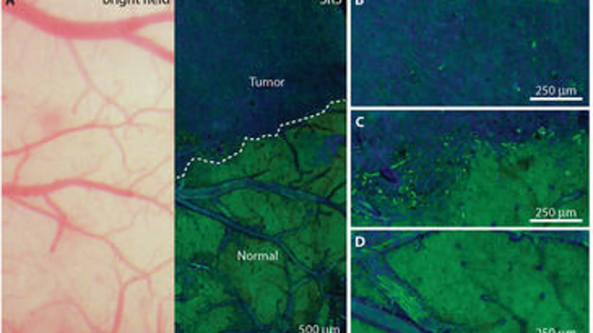 Comparación de dos imágenes de tejido cerebral canceroso, una obtenida con microscopía convencional (izquierda) y la otra mediante SRS (derecha). En la última se aprecian claramente los límites del área tumoral