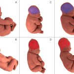 Reconstrucción tridimensional de los huesos craneales antes del parto y durante la segunda parte del mismo. / Ami et al