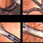 La técnica no viene como sustitutiva sino como complementarias de los tratamientos ya existentes para la reducción de volumen pulmonar por enfisema