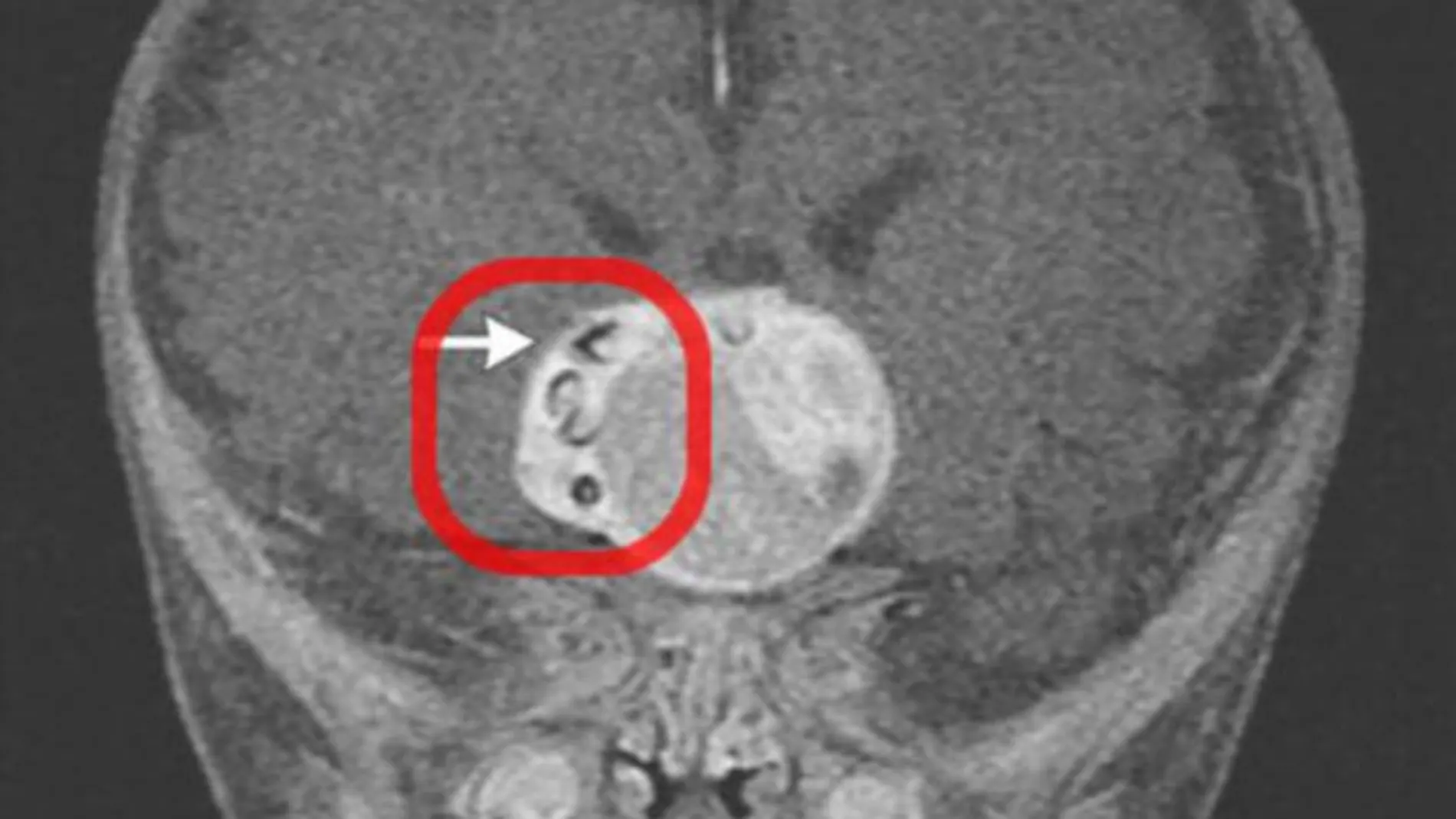 El recuadro rojo muestra las dos piezas dentales insertada en la masa cancerígena antes de ser extirpada