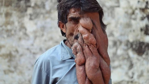 La insoportable existencia del «hombre elefante» indio