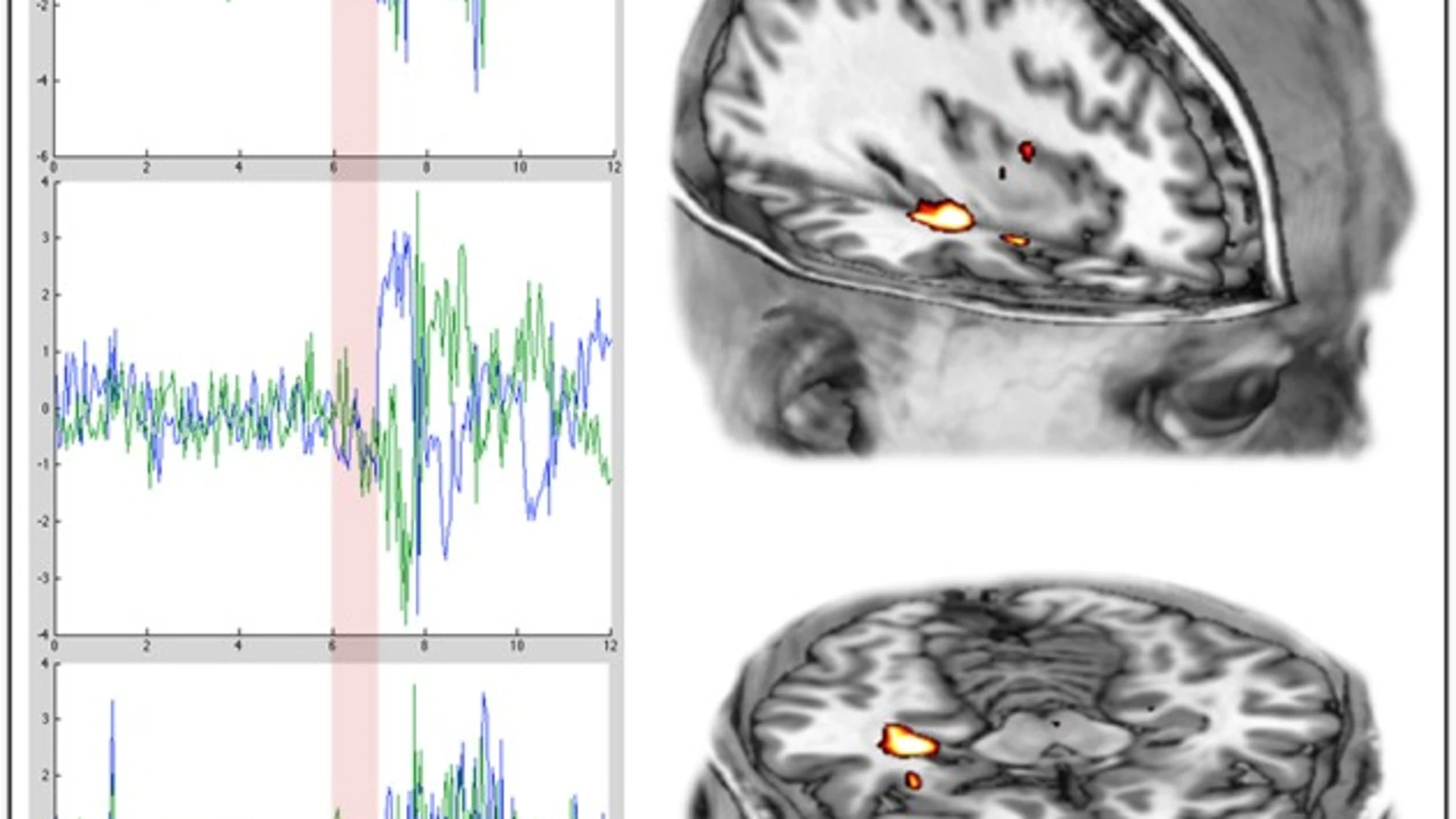 Las tres gráficas de la izquierda muestran la actividad cerebral de tres sujetos antes y después (separación en rojo) de una infusión de psilocibina. A la derecha se aprecia la activación del hipocampo