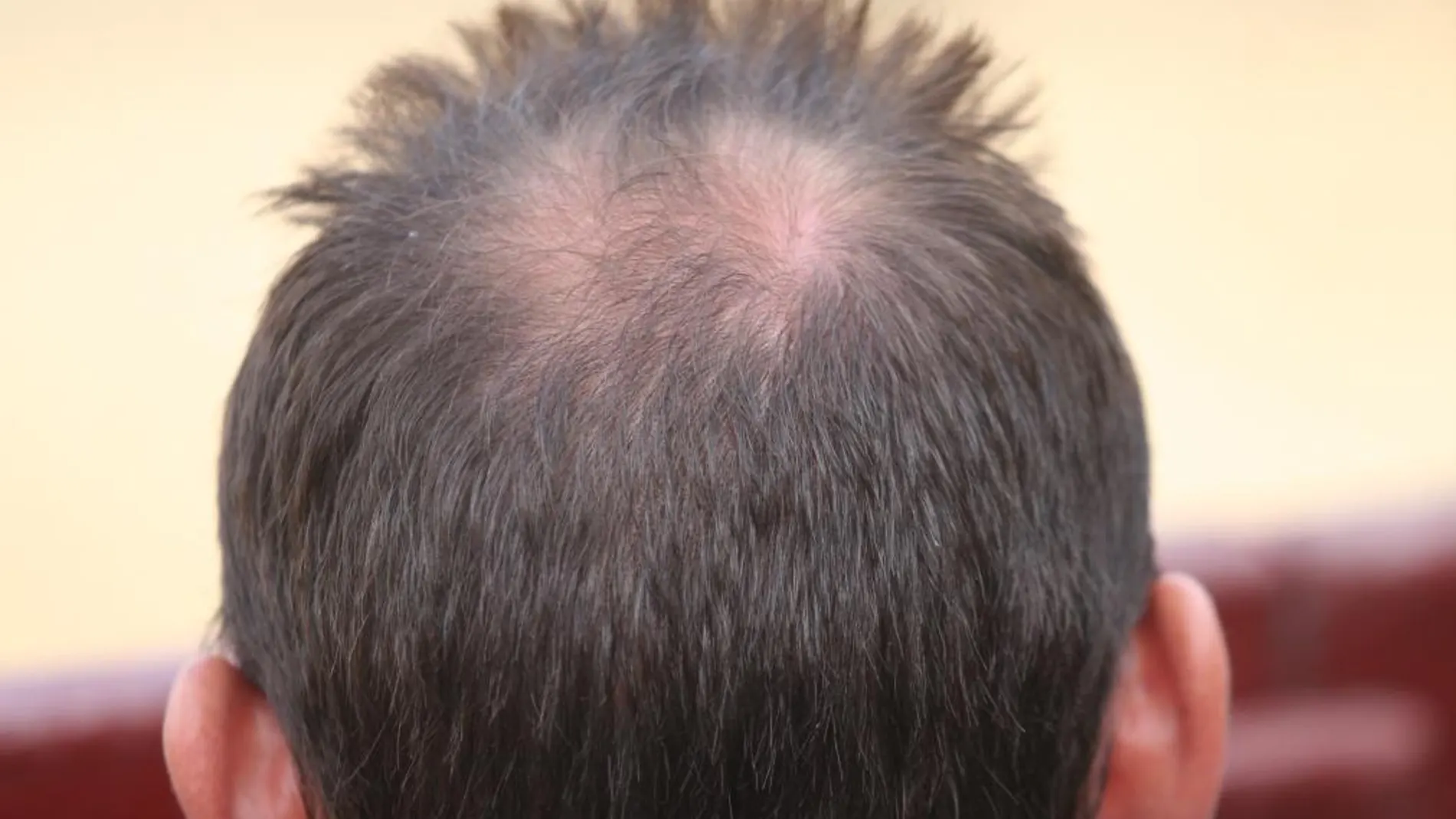 La pérdida de cabello hace a los hombres sentirse menos atractivos