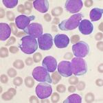 Frote sanguíneo de precursores linfocíticos en una leucemia linfoide aguda