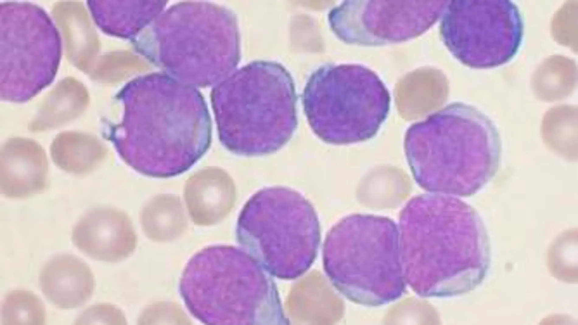 Frote sanguíneo de precursores linfocíticos en una leucemia linfoide aguda