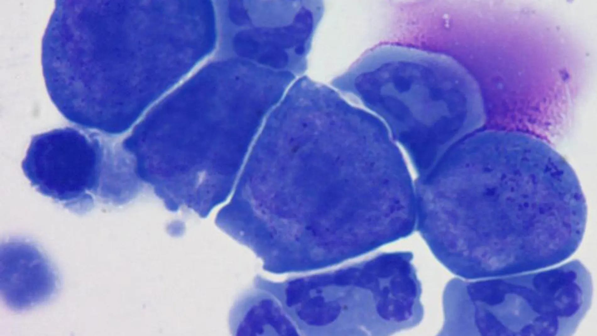 Más del 80% de los casos de cáncer de próstata son curables
