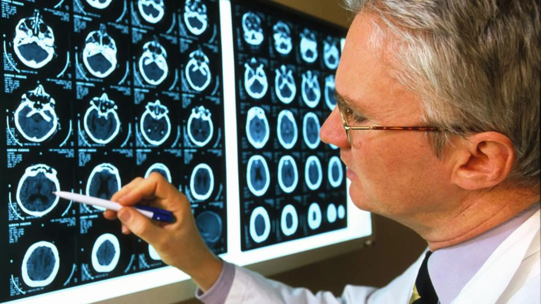 Un médico analiza las consecuencias del alzhéimer en una radiografía