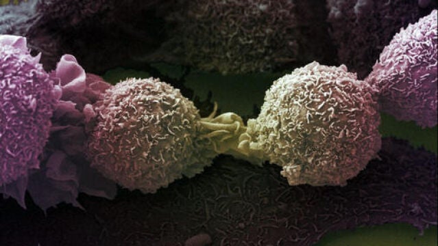 Células cancerígenas de pulmón