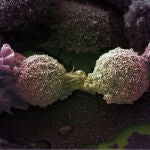 Células cancerígenas de pulmón