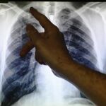 Radiografía de unos pulmones