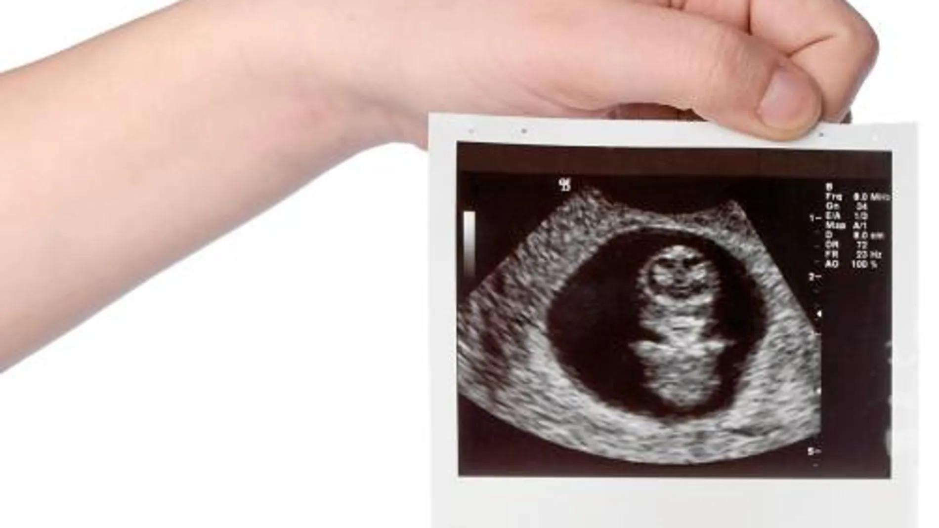 Uno de cada cinco embarazos acaba en aborto