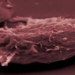 Imagen microscópica de un melanoma