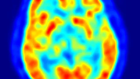 Pruebas en el cerebro a un paciente con párkinson