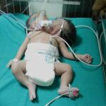 Una mujer da a luz a una niña con dos cabezas en India
