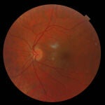 Imagen de fondo de ojo obtenida a través de un oftalmoscopio. Imagen: DavidHardman