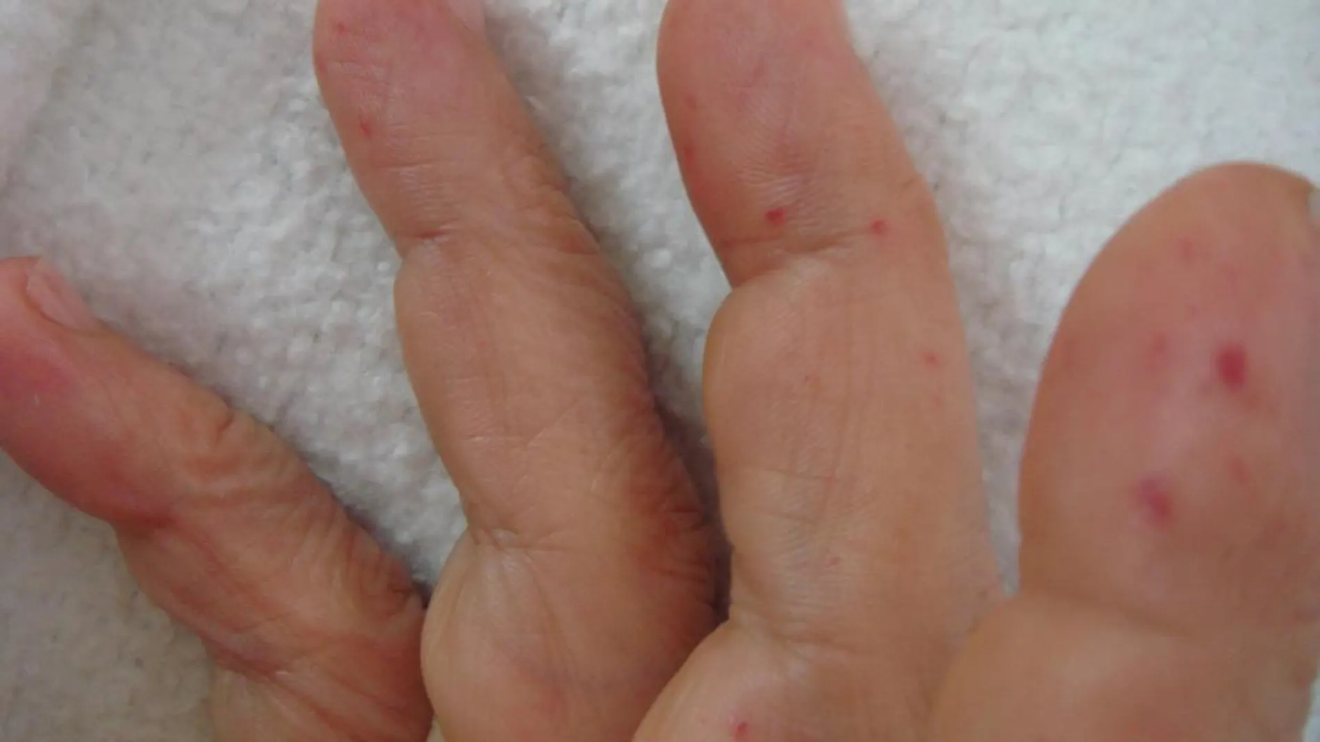 Microaneurismas en los dedos de una persona afectada por el síndrome de Rendu-Osler