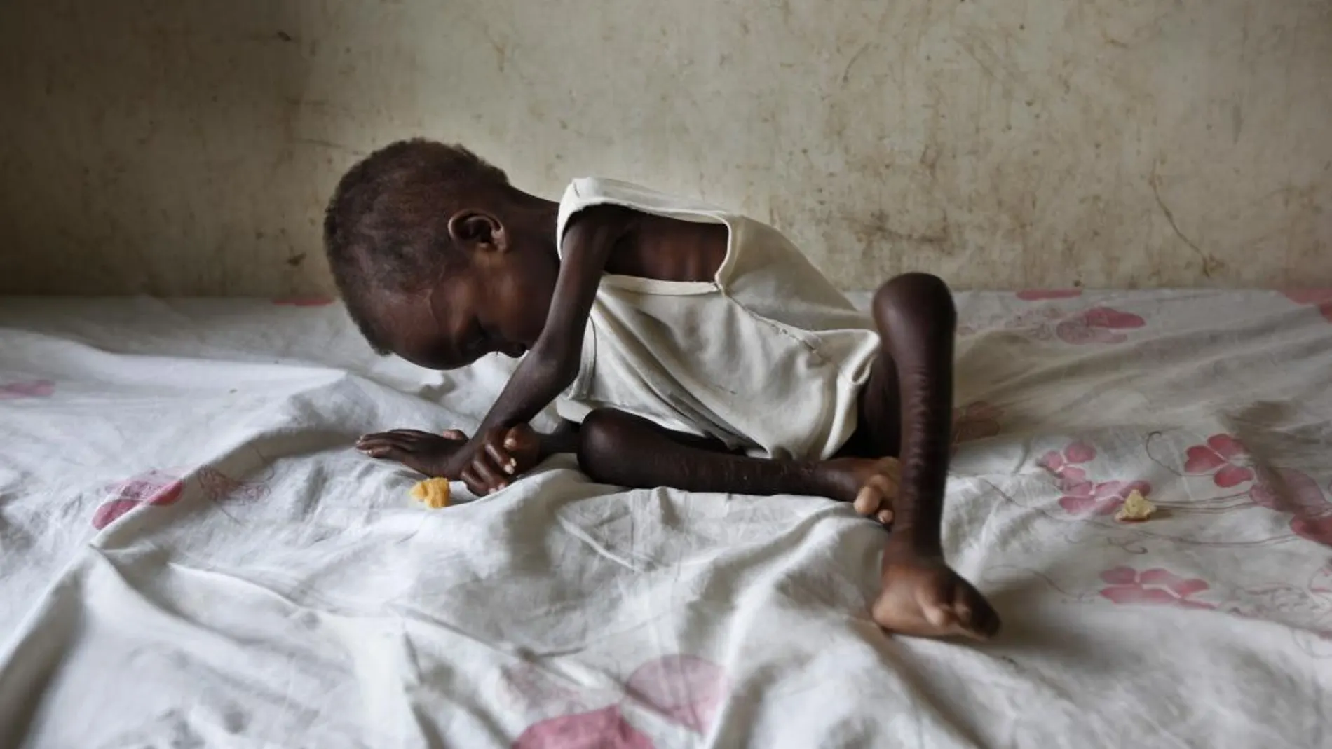 Un niño malnutrido en Sudán