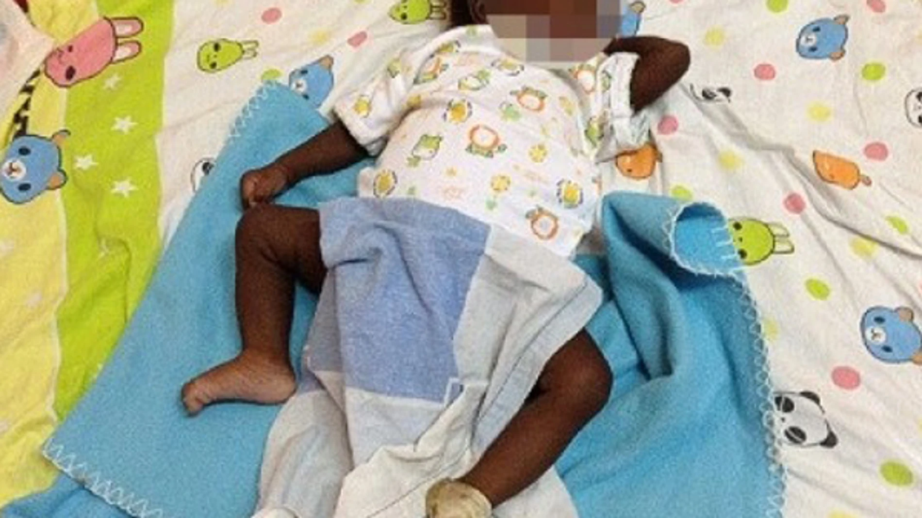 Nace un niño con ocho extremidades en Uganda