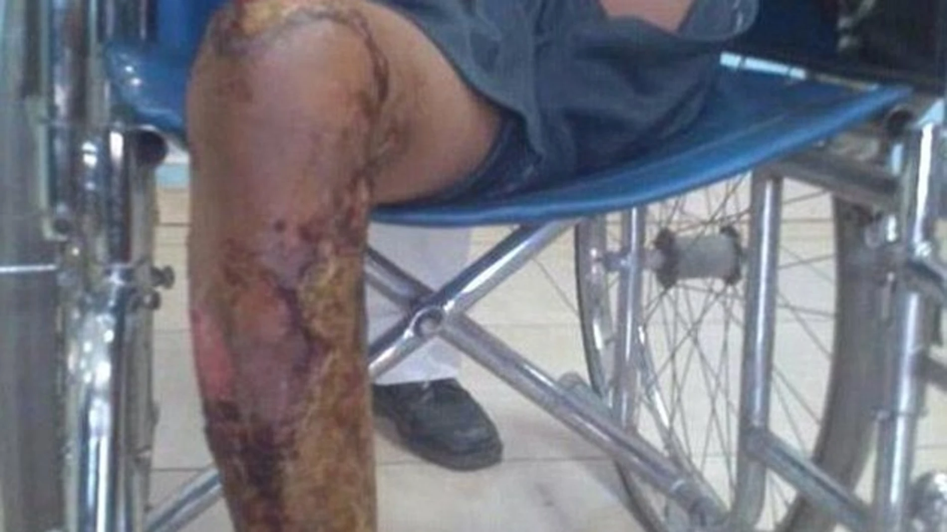 Imagen del estado de la pierna del menor quemado