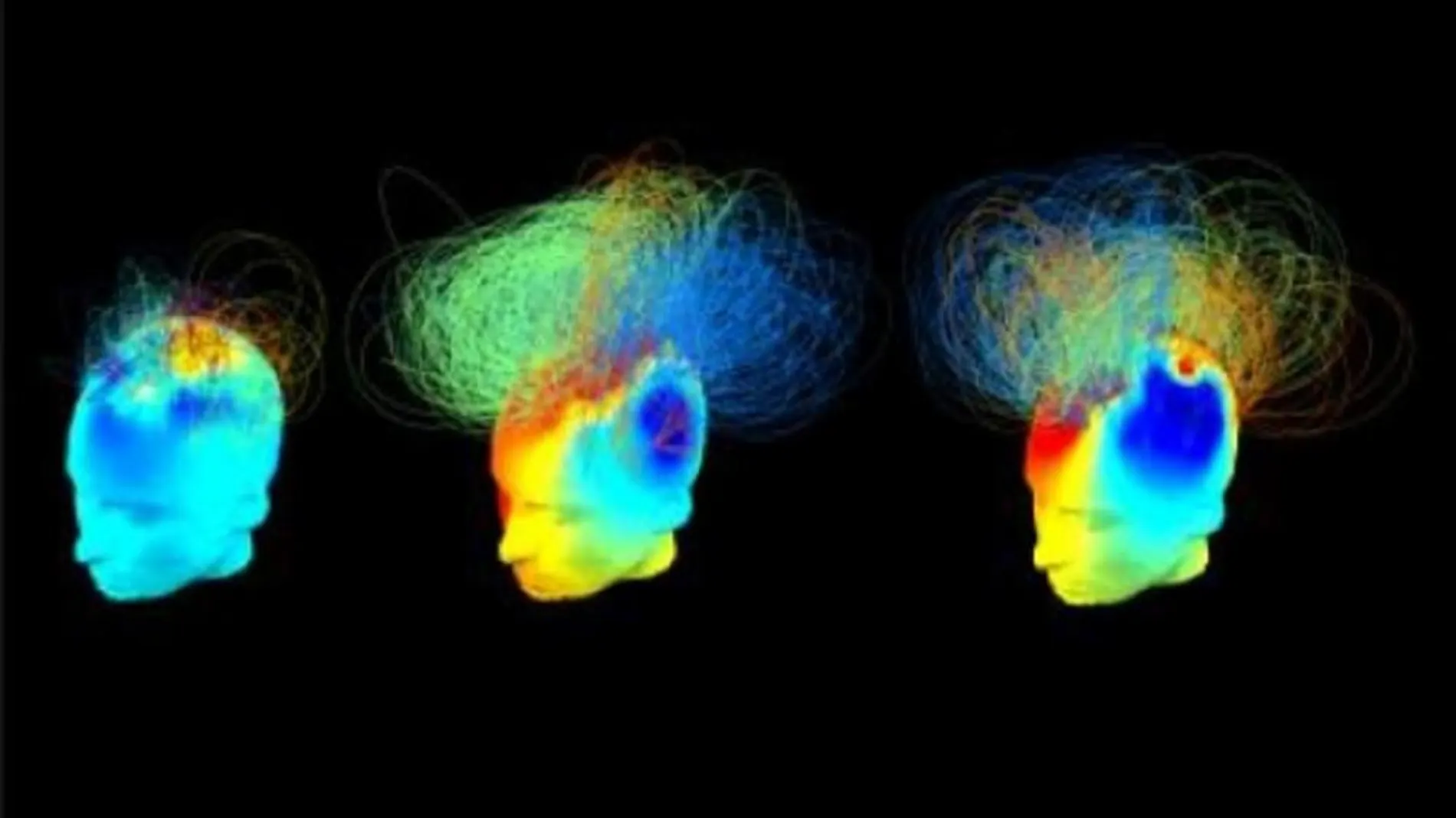 Redes cerebrales en dos pacientes en estado vegetativo (izquierda y centro) conductualmente iguales. Sin embargo, la actividad neuronal del paciente del centro cuando se le ordenó que se imaginara jugando al tenis es similar a la de la persona de la derecha (un adulto sano)