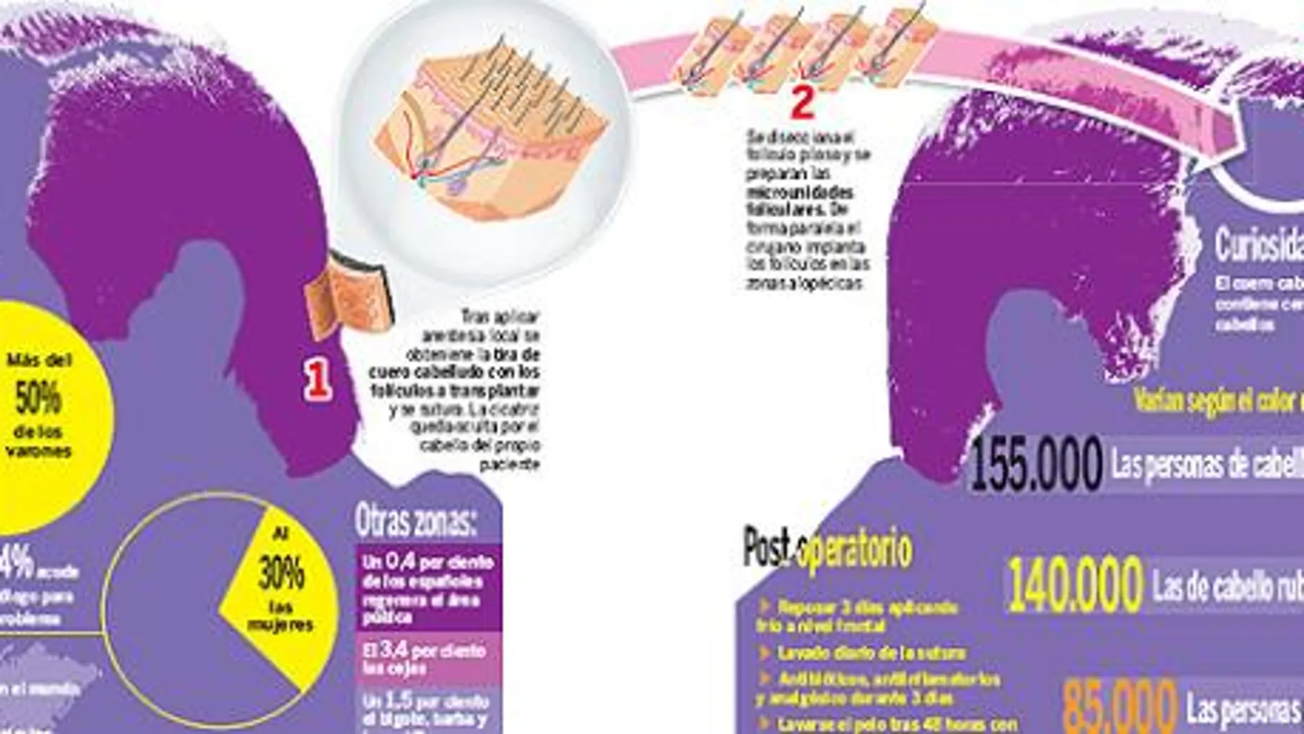 Injertos: la gran esperanza del hombre calvo