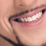 Microinjertos en la barba, la última tendencia