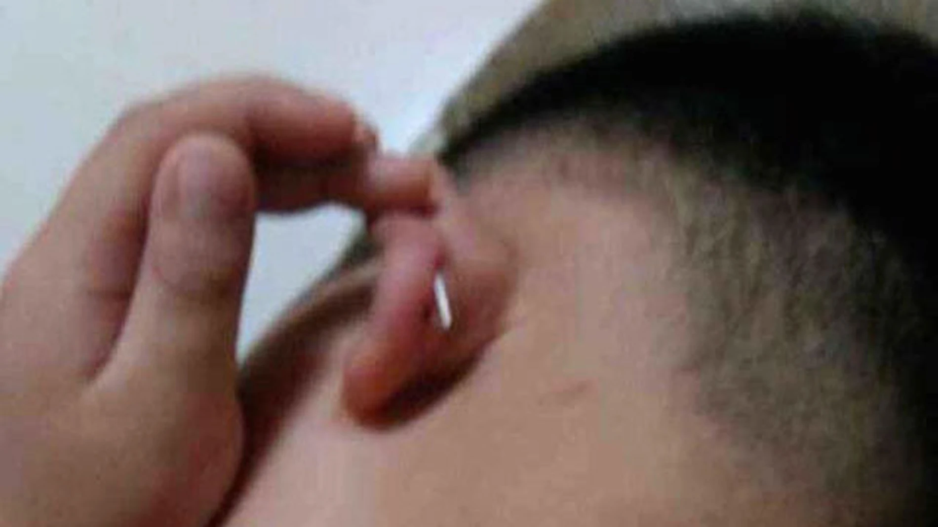 La madre del niño compartió esta imagen de la grapa en la oreja del niño