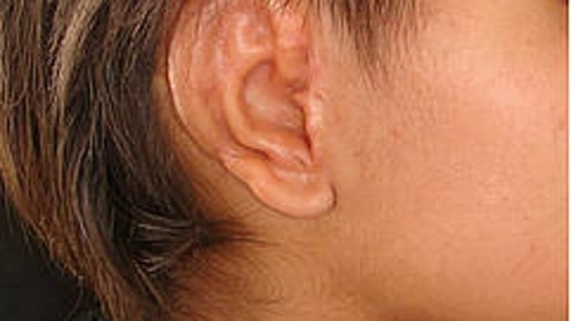 Apariencia de una oreja reconstruida