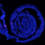 Sección de colon de ratón con cáncer de colorectal, en el que se pueden visualizar los núcleos celulares (azul) y los linfocitos T (rosa).