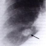 Nódulo pulmonar causado por ‘Dirofilaria immitis’ en una persona