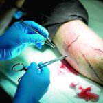 Las suturas antisépticas reducen en más de un 50% las infecciones quirúrgicas