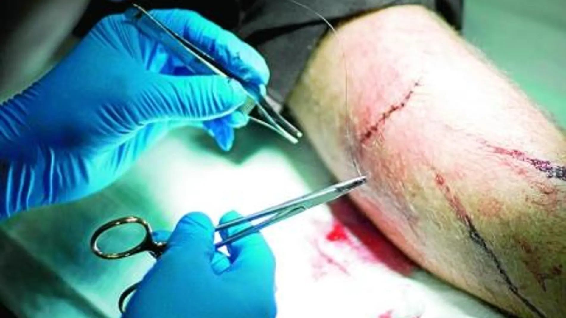 Las suturas antisépticas reducen en más de un 50% las infecciones quirúrgicas