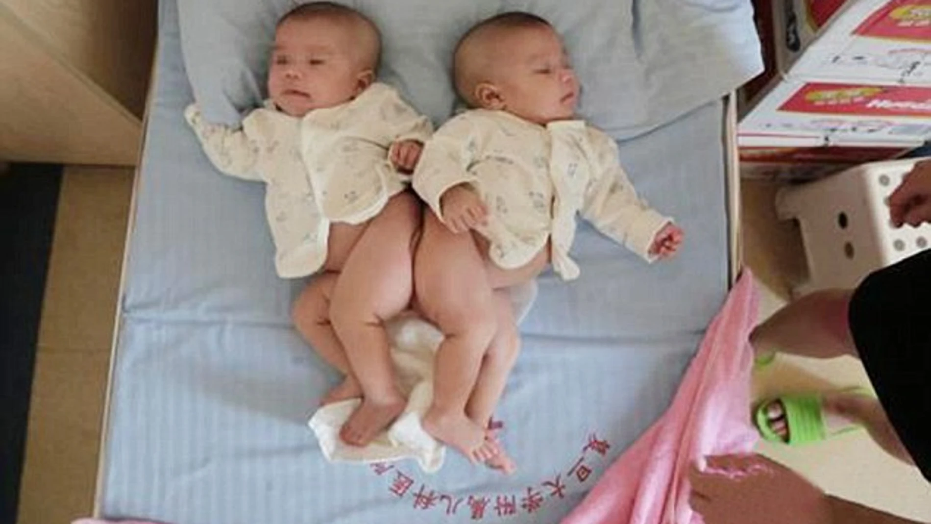 Imagen de las dos hermanas antes de la operación
