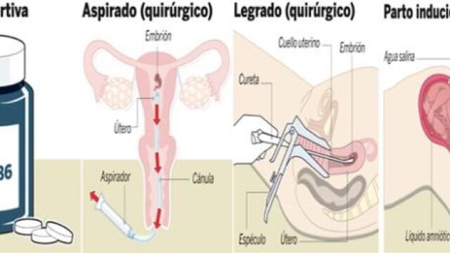 Los expertos piden anestesia para los fetos en los abortos