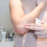 La psoriasis se produce una proliferación excesiva de las células de la piel.