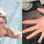 3- Los médicos practicaron también varios injertos durante el largo proceso de reconstrucción. 4- Aspecto actual de su mano tras ser sometido a las diez intervenciones quirúrgicas