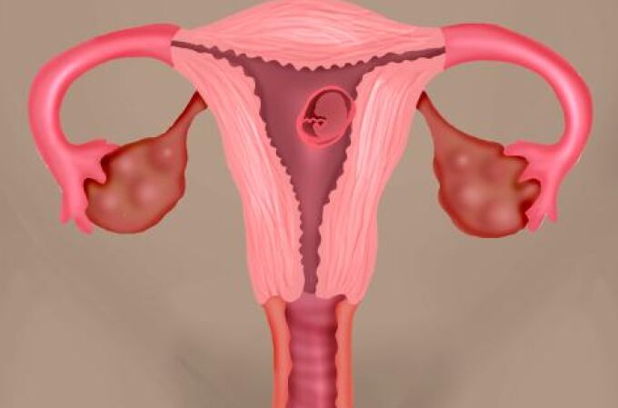 La supervivencia por cáncer de ovario varía hasta un 20% según el especialista que lo trate