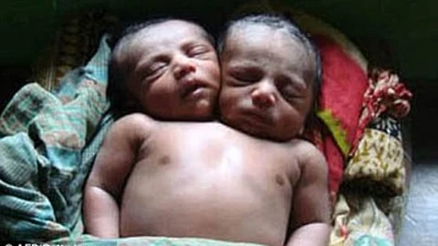 Nace en Brasil un niño con dos cabezas