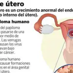  Científicos españoles identifican los ocho tipos de virus «culpables» del cáncer de útero