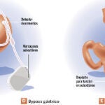 Obesidad: la cirugía para mórbidos llega a los jóvenes