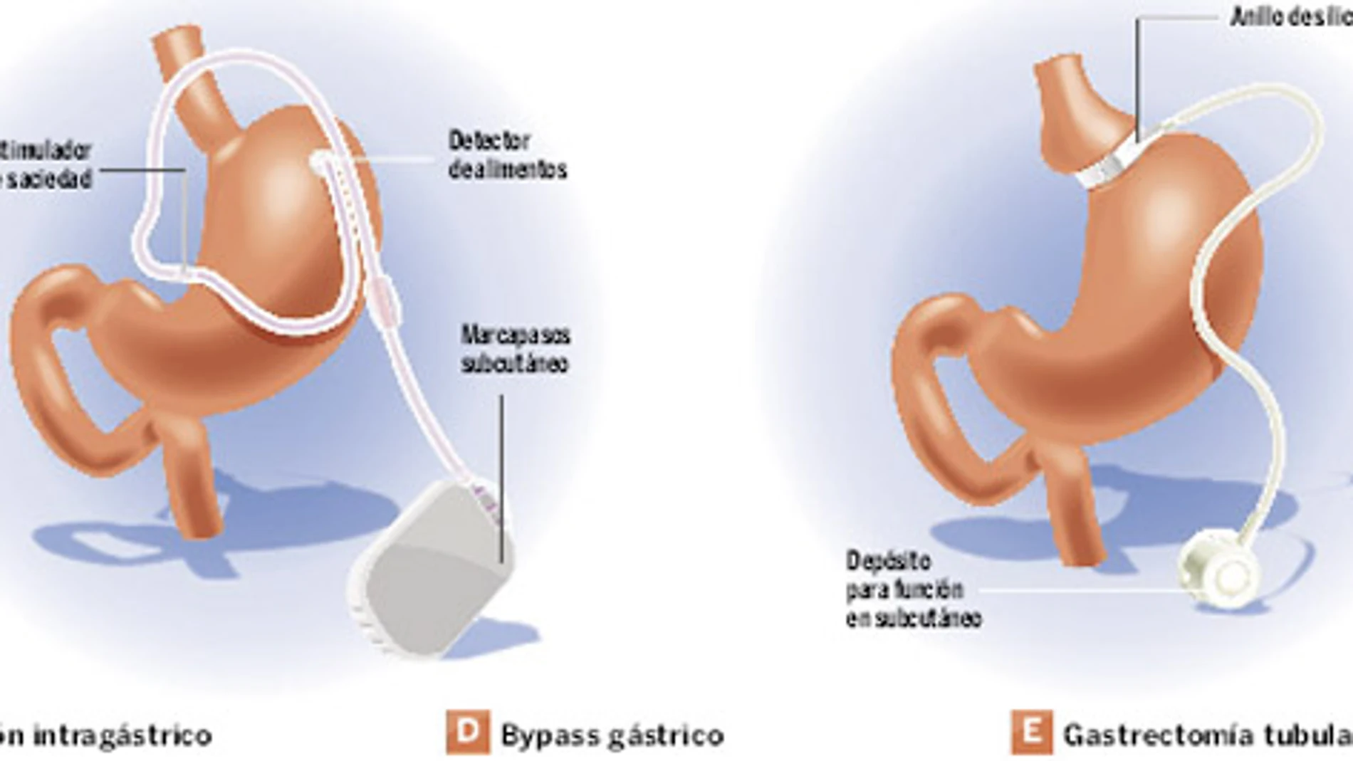 Obesidad: la cirugía para mórbidos llega a los jóvenes