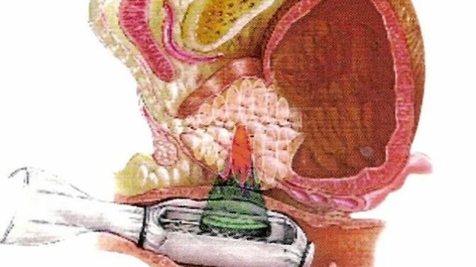 Nuevo sistema de tratamiento del cáncer de próstata