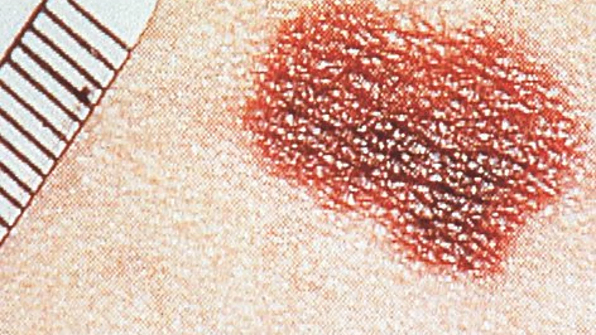 MÁS SUPERVIVENCIA PARA EL CÁNCER DE PIEL AVANZADO