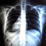 Preparan la primera radiografía del cáncer de pulmón femenino
